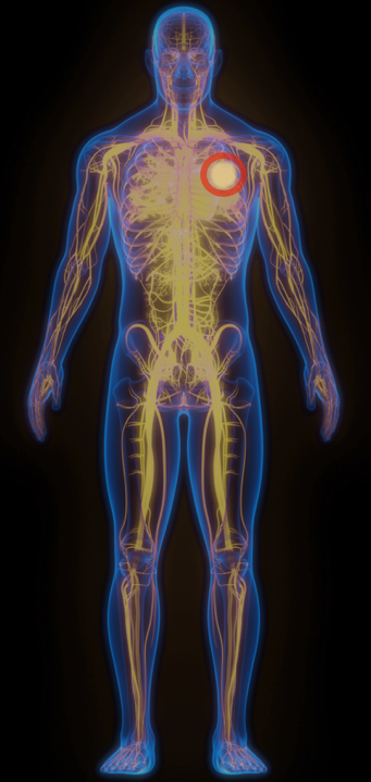 Human body icon outlining an example of the effects of non–tumor selective immunotherapies for a person with lung cancer