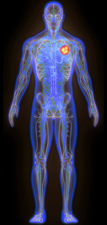 Human body icon outlining an example of the effects of tumor-selective immunotherapies for a person with lung cancer